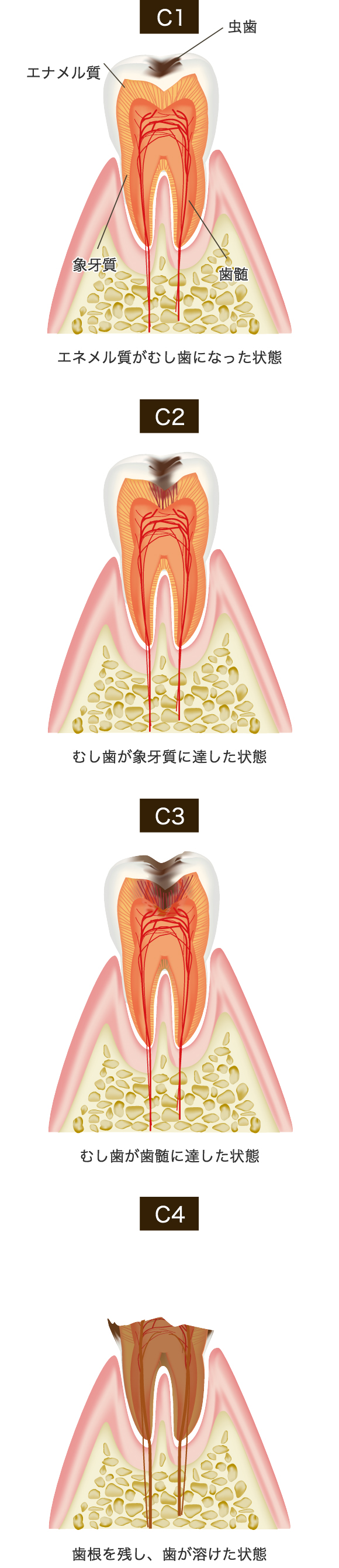 痛みが出た時は、時すでに遅し！？