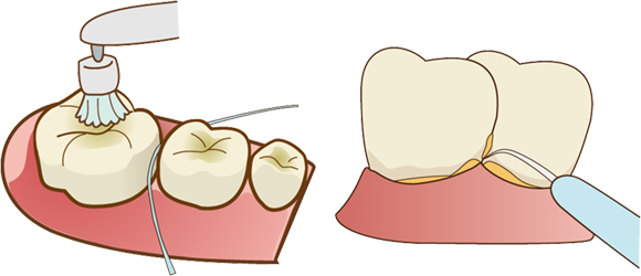歯周病はどうやって治療する？